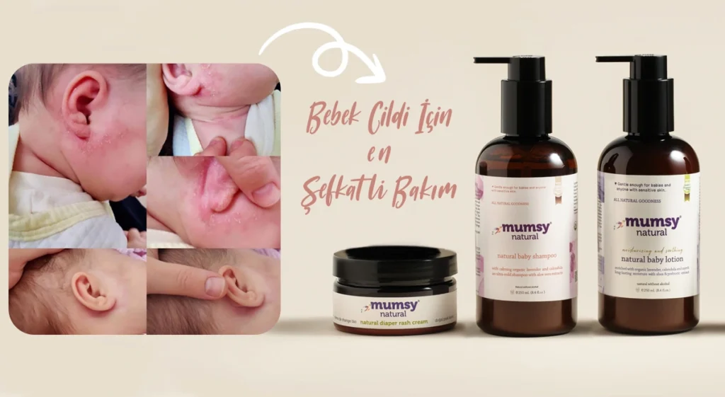 Bebeklerde Kulak Arkası Pişiğine Ne iyi Gelir? kulak arkası pişiğine Mumsy Natural Bebek cilt bakım ürünleri iyi gelir