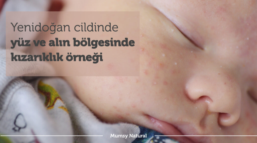 Bebekte yüz ve alın bölgesinde kızarıklık örneği