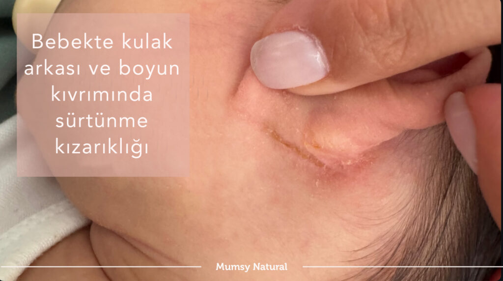 Bebekte kulak arkası ve boyun kıvrımında sürtünme kızarıklığı