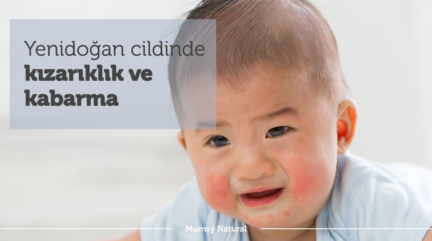 Yenidoğan bebekte kızarıklık ve kabarma genel görünüm