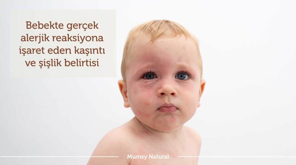 Bebekte gerçek alerjik reaksiyona işaret eden kaşıntı ve şişlik belirtisi