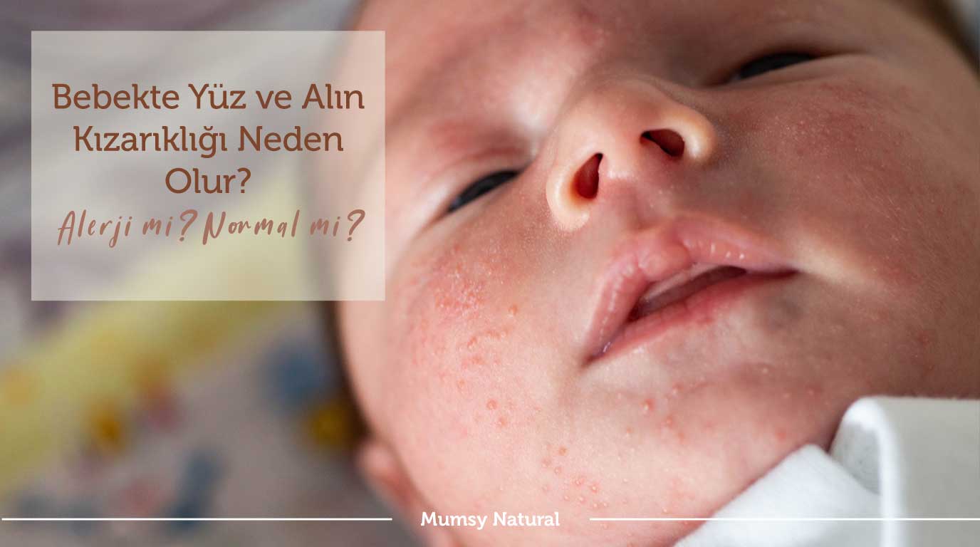 Bebekte yüz ve alın bölgesinde kızarıklık görünümü